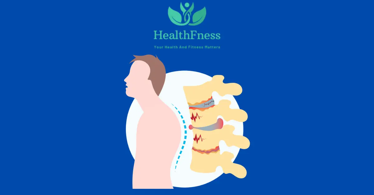 Ankylosing spondylitis