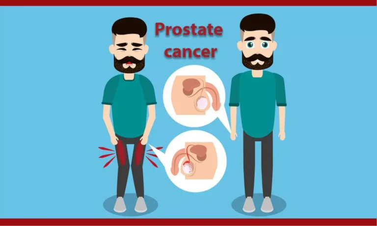 Prostate Cancer