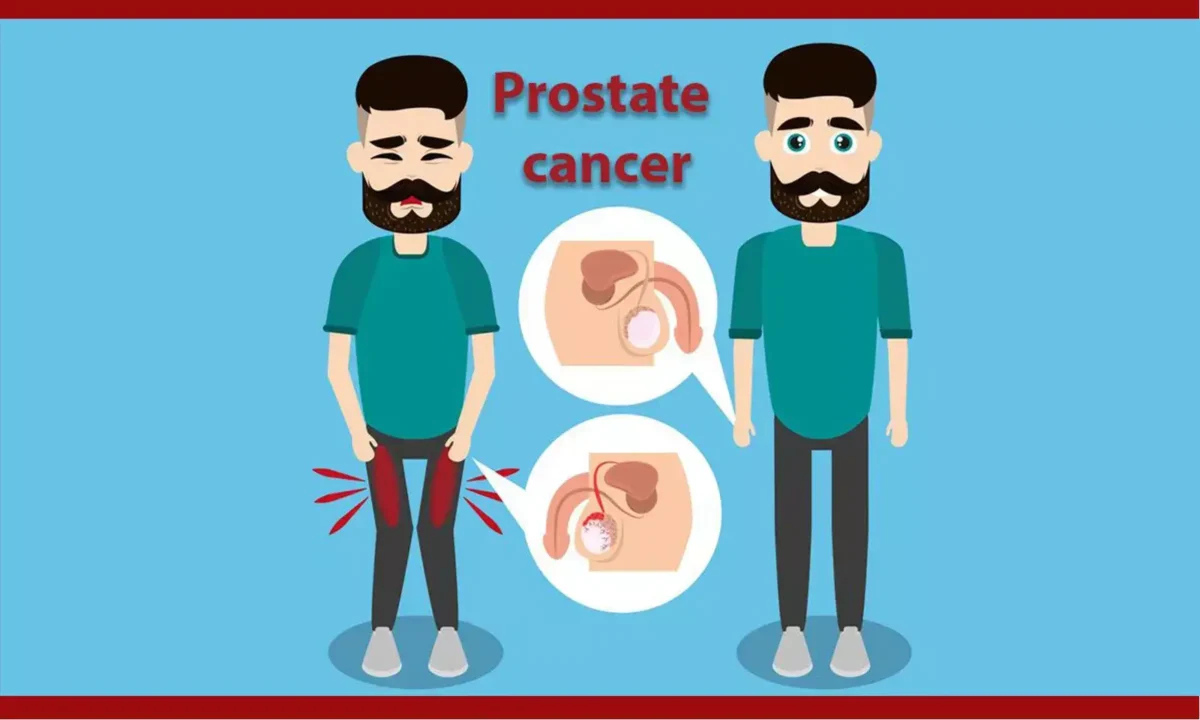 Prostate Cancer Causes Symptoms And Astonishing Treatment 2023 Healthfness 4103