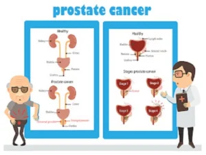 Prostate Cancer: Causes, Symptoms, and Astonishing Treatment (2023)