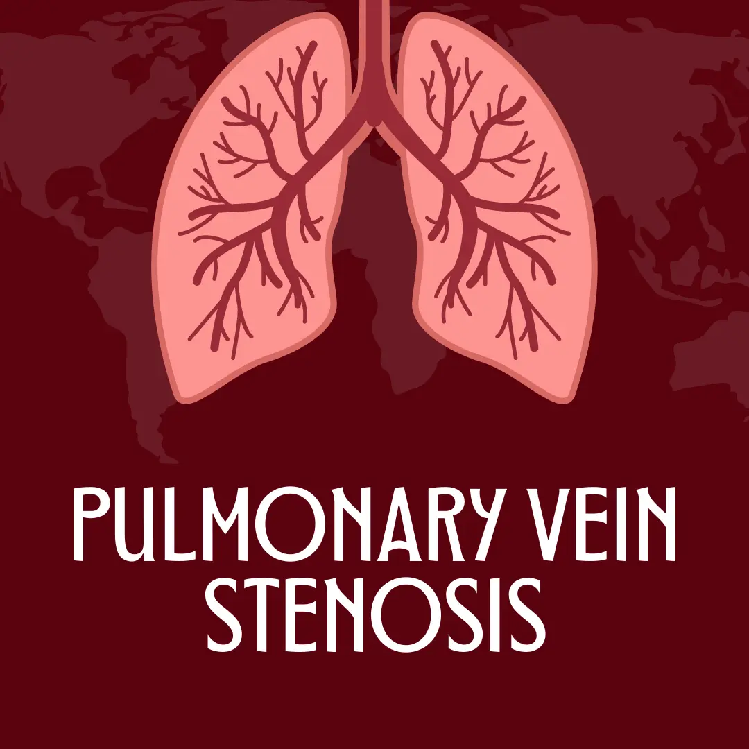 Pulmonary Vein Stenosis: Causes, Symptoms and Treatment 2023 An anatomical illustration depicting the constriction and narrowing of pulmonary veins, indicative of pulmonary vein stenosis. π«ππ©Ί