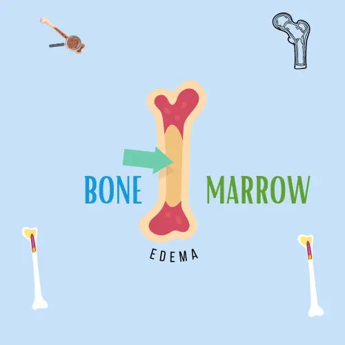 Understanding Bone Marrow Edema Causes, Symptoms, and Treatment