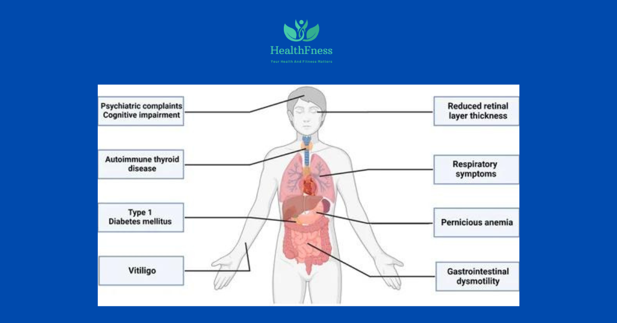 Can Stiff Person Syndrome Kill You? Causes, Symptoms And Treatment2024 Can Stiff Person Syndrome Kill You? Causes, Symptoms And Treatment2024