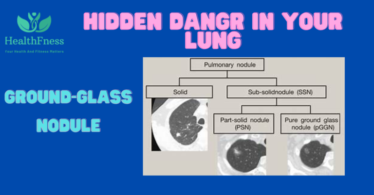 An image depicting a floor glass nodule in the lung, characterised by way of a cloudy opacity on a clinical test.