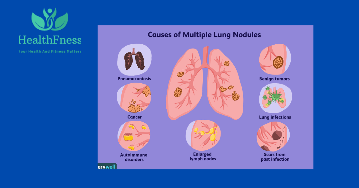 Ground Glass Nodule: The Hidden Danger in Your Lungs Ground Glass Nodule: The Hidden Danger in Your Lungs