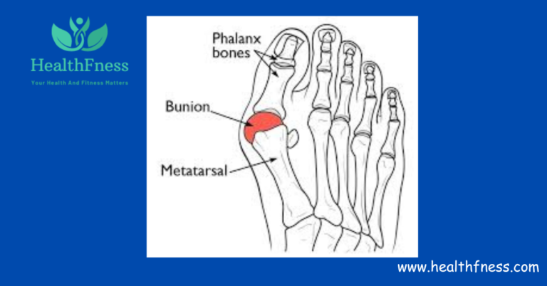Lapiplasty Bunion Surgery: Cons And Pros2024