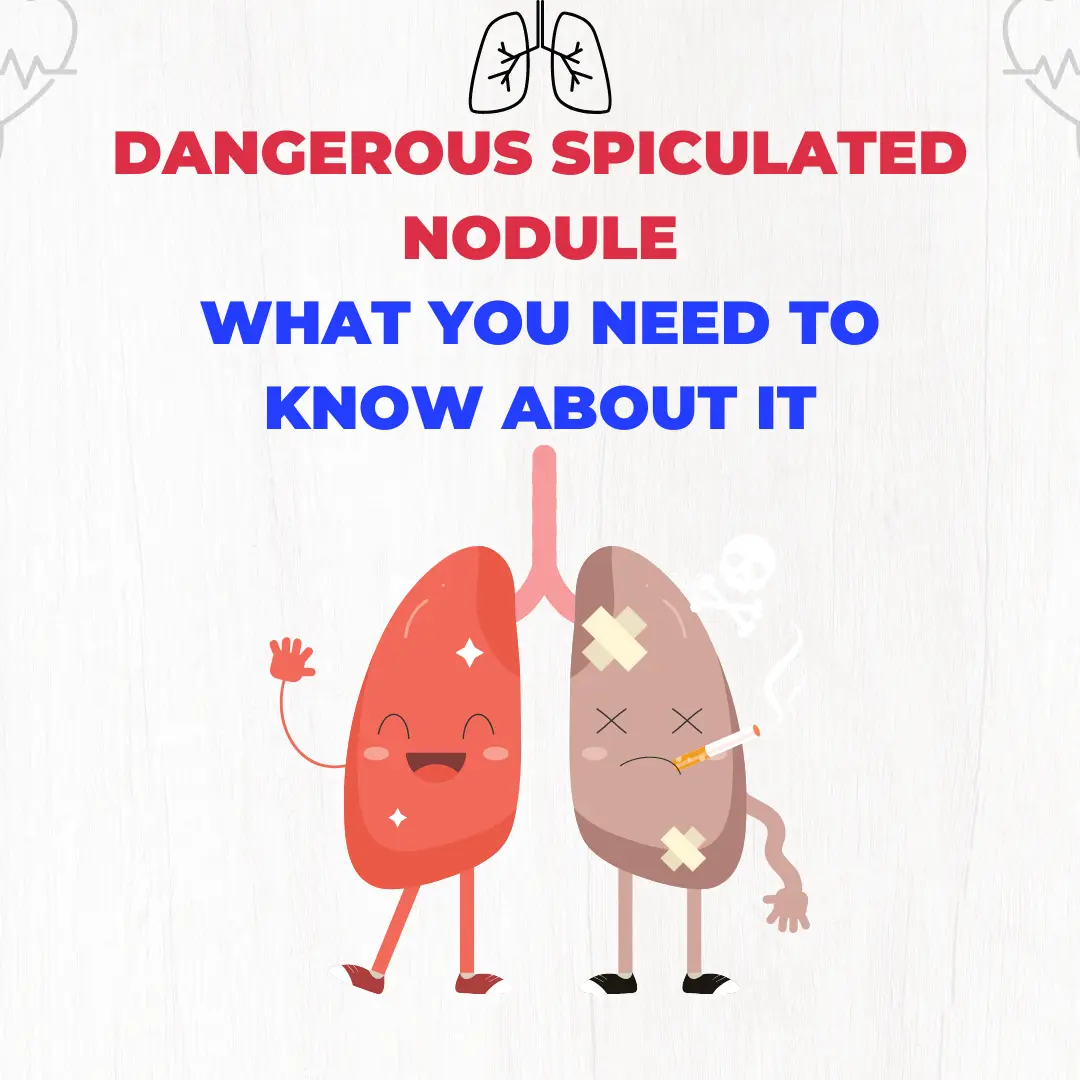 Dangerous Spiculated Nodule: What You Need to Know About It | HealthFness