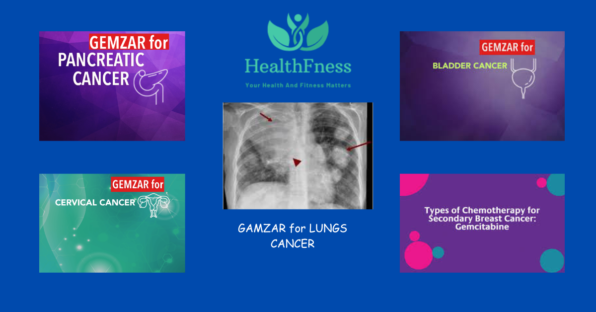 Understanding Gemzar: Uses, Side Effects, And Benefits As A Chemotherapy Drug Understanding Gemzar: Uses, Side Effects, And Benefits As A Chemotherapy Drug