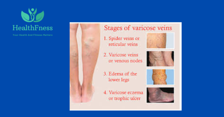 A drawing of a person with legs covered in varicose veins. The veins seem twisted, larged, and visible through the skin. The graphic draws attention to the possible discomfort and aesthetic issues that come with varicose veins.