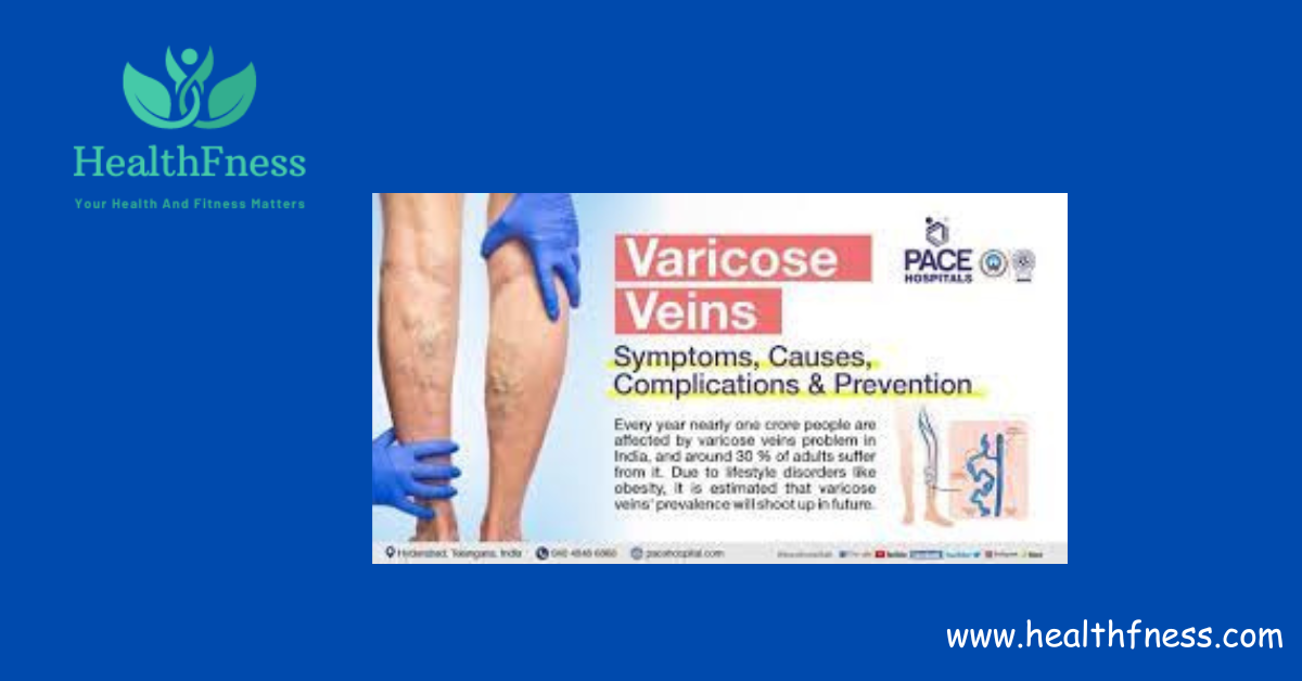 When To Worry About Varicose Veins: When It's Time to Take Action2024