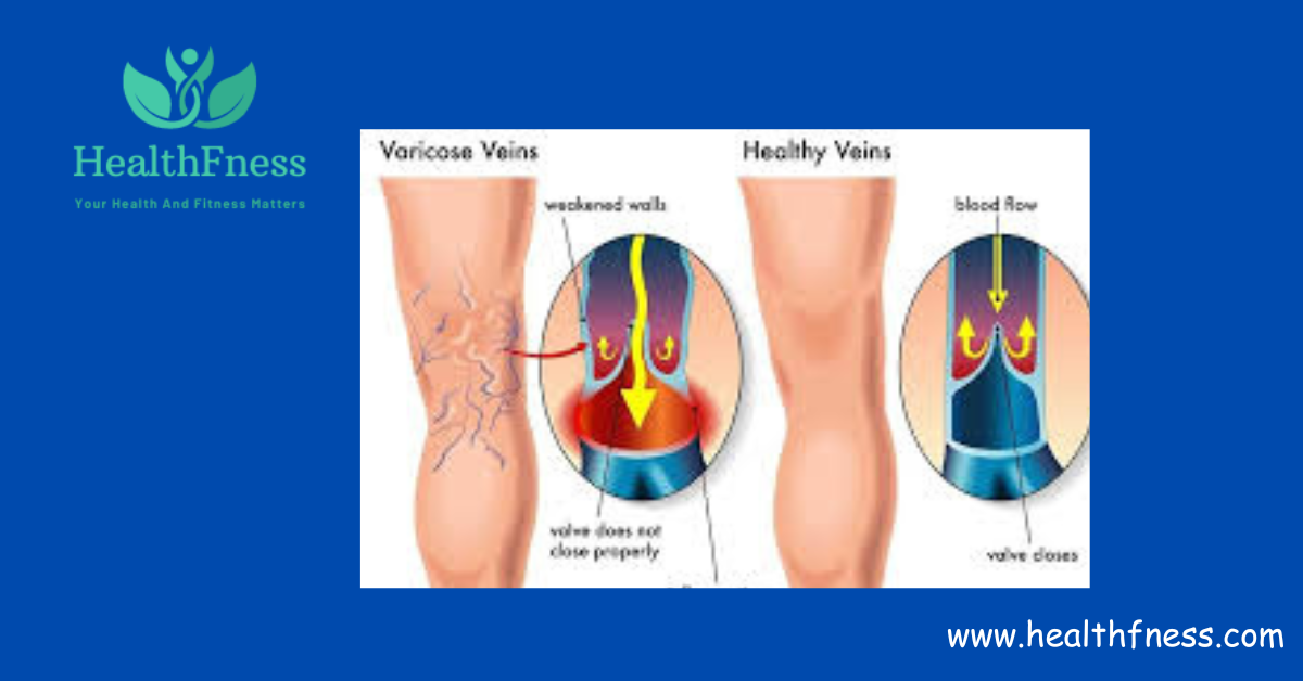 When To Worry About Varicose Veins: When It's Time to Take Action2024
