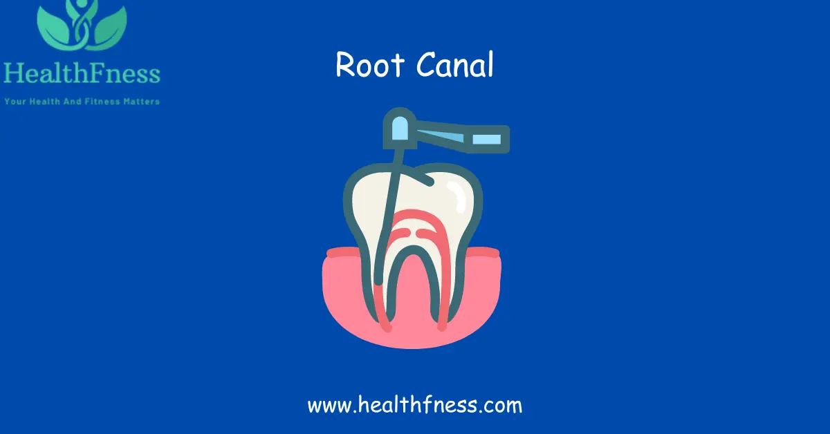 How Long Does a Root Canal Take