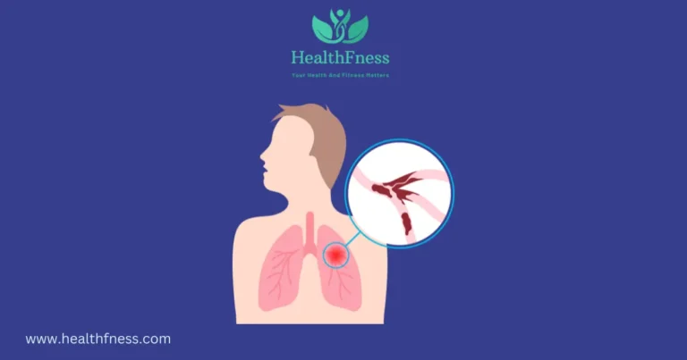 Can You Get Disability for Pulmonary Embolism?