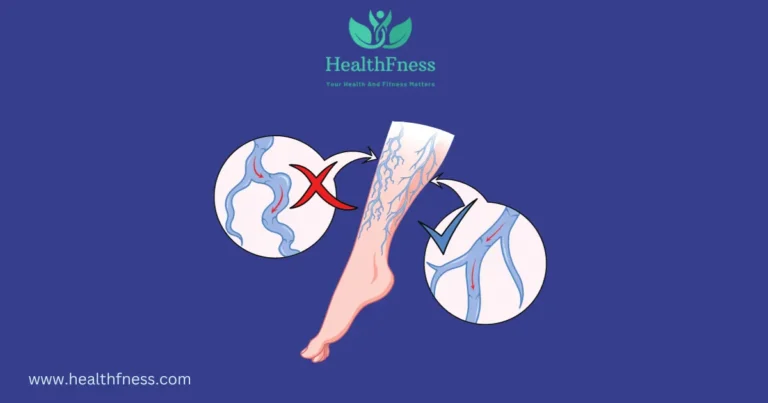 Does Smoking Cause Varicose Veins?