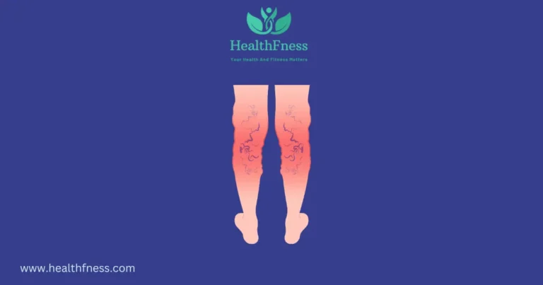 How to Treat Varicose Veins with Turmeric