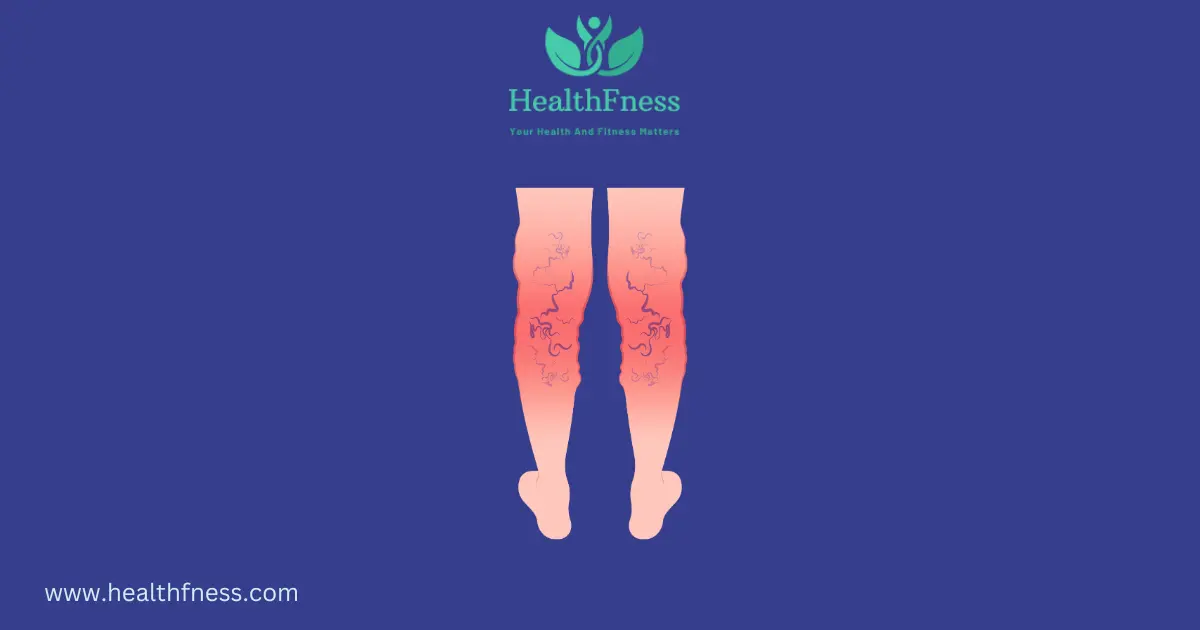 How to Treat Varicose Veins with Turmeric? HealthFness