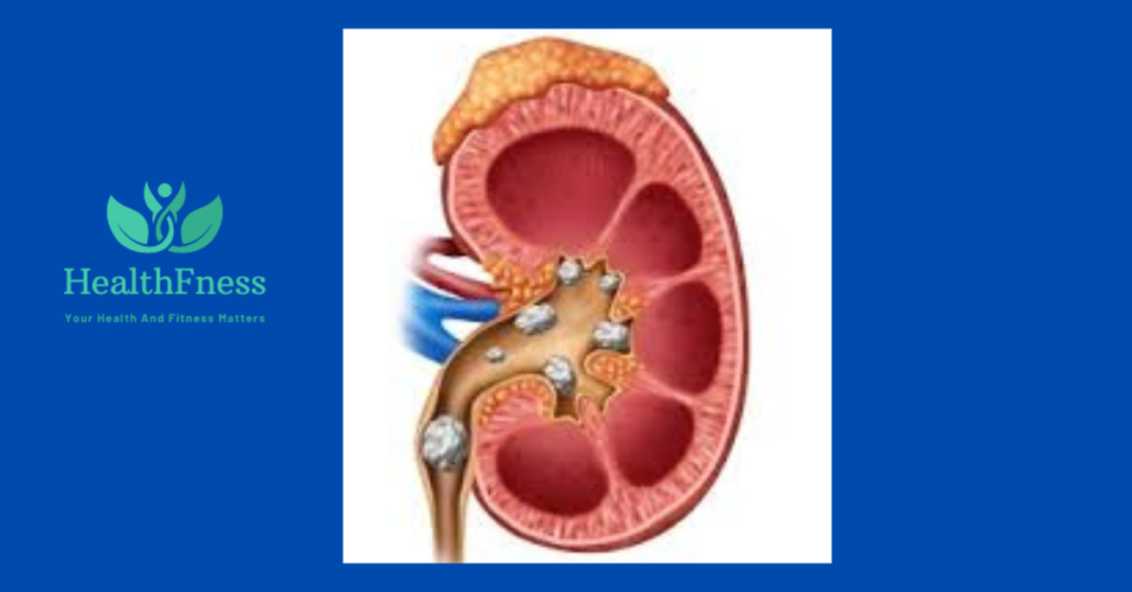 Semaglutide Kidney Stones: Unveiling the Hidden Risks and Answers 2024 ...